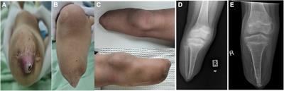 Case Report: Halting terminal osseous overgrowth post tibia amputation in children: a report of three cases